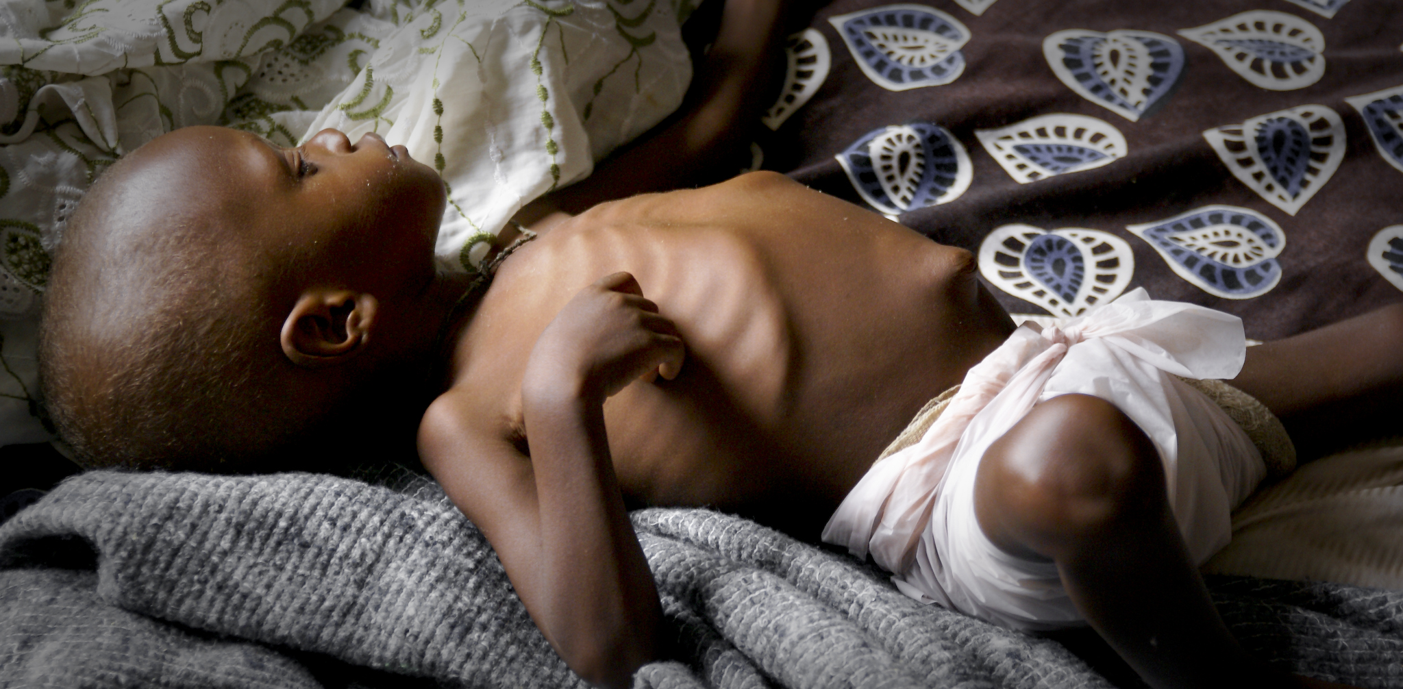 kid suffering from malnutrition sierra leone masanga